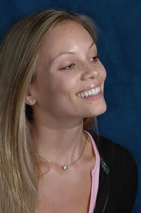 Veneers: Katherine - After