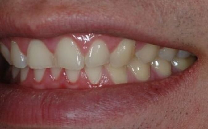 Dental Crowns : Patrick - Before