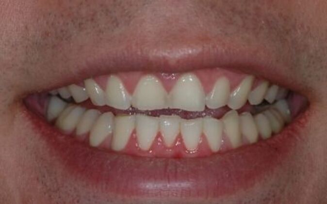 Dental Crowns  Patrick - Before