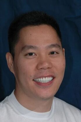 Dental Crowns : Patrick - After