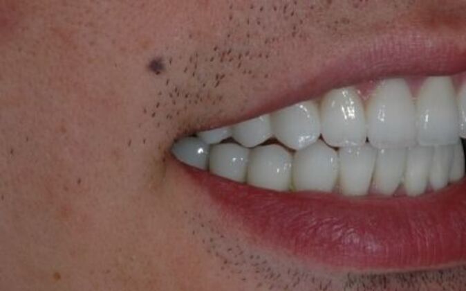 Dental Crowns : Patrick - After