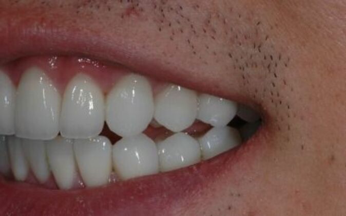 Dental Crowns : Patrick - After