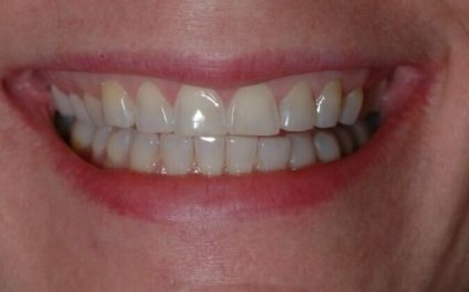 Veneers Laura - Before