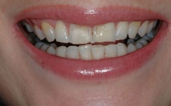 Veneers Dina 2 - Before
