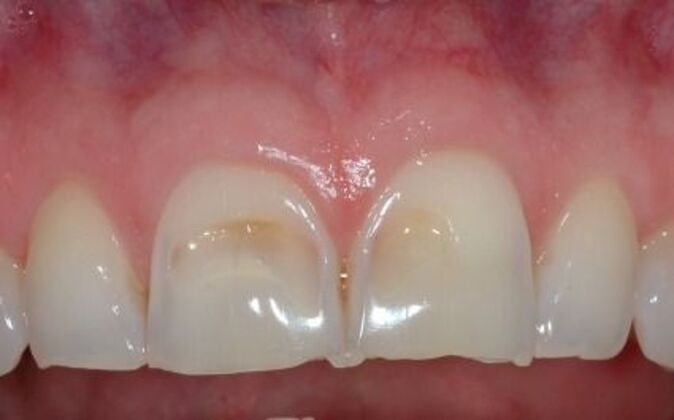 Veneers: Dina 2 - Before