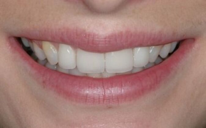 Veneers Dina 2 - After