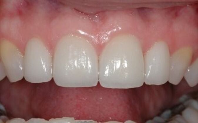 Veneers: Dina 2 - After