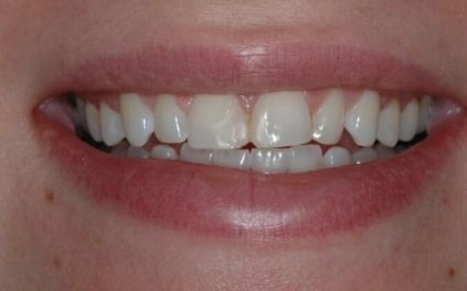 Veneers Michelle - Before