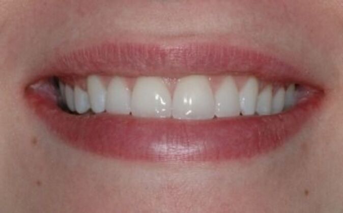 Veneers Michelle - After