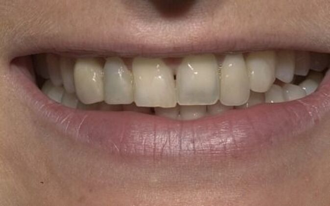 Dental Bridge Caroline - Before