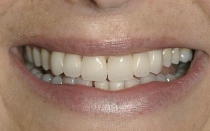 Dental Bridge Caroline - After