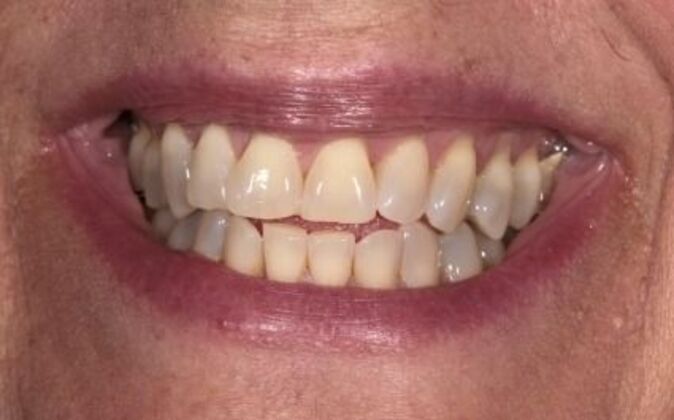 Smile Makeover Debra - Before