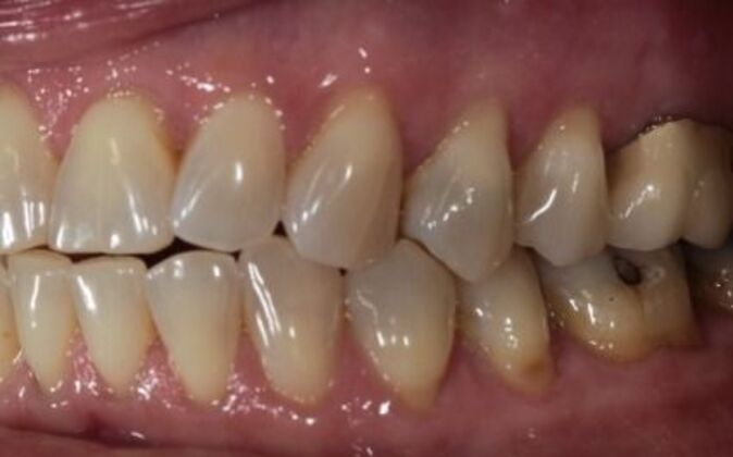 Smile Makeover: Debra - Before