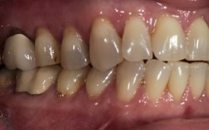 Smile Makeover: Debra - Before