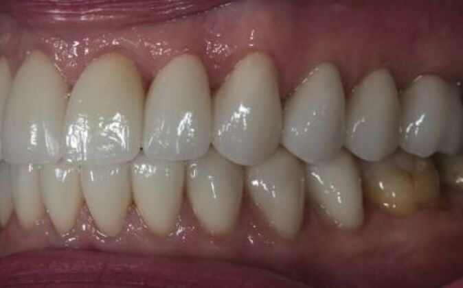 Smile Makeover: Debra - After