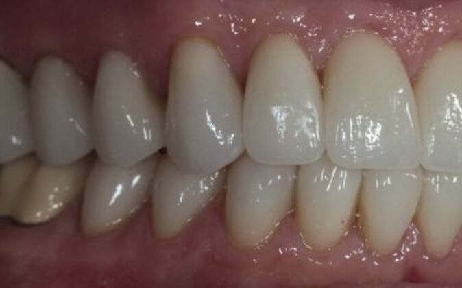 Smile Makeover: Debra - After