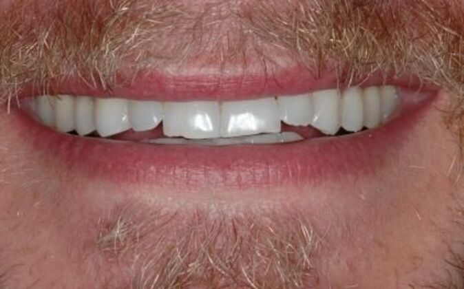 Veneers Shawn - Before