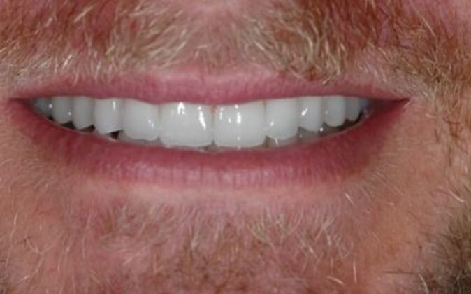 Veneers Shawn - After