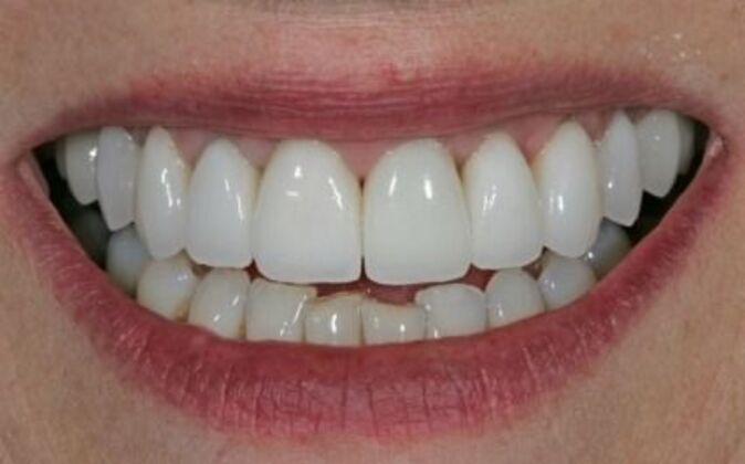 Smile Makeover Patricia - After