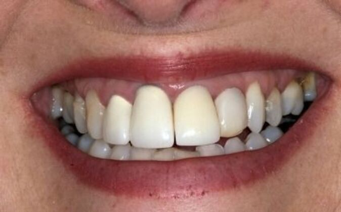 Smile Makeover Patricia - Before