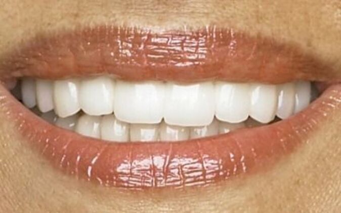 Veneers Rosa - After