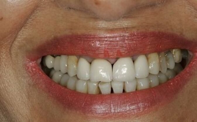 Veneers Rosa - Before