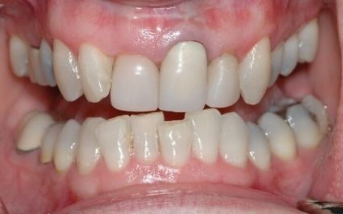Dental Crowns : Emyleen - Before