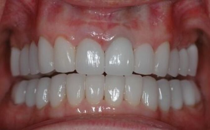 Dental Crowns : Emyleen - After