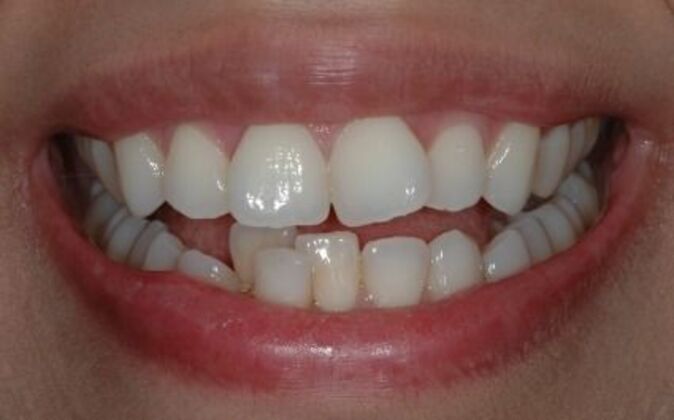 Invisalign Isabel - Before