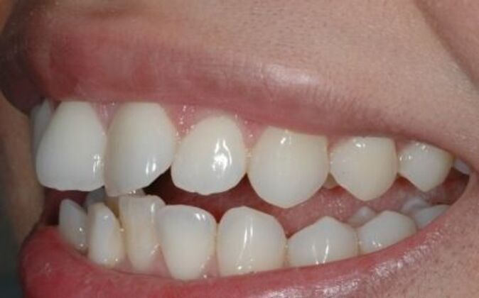 Invisalign: Isabel - Before