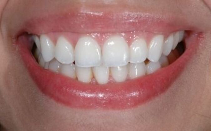 Invisalign Isabel - After