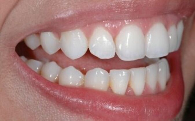 Invisalign: Isabel - After