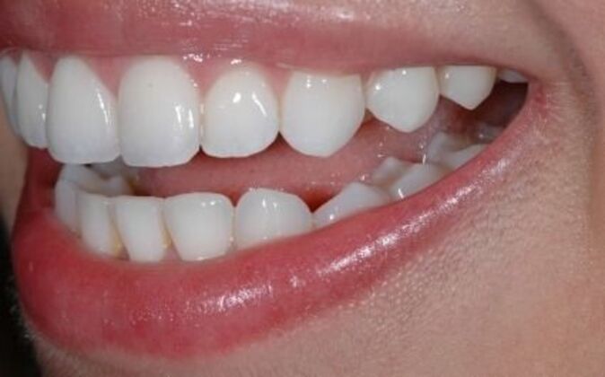 Invisalign: Isabel - After