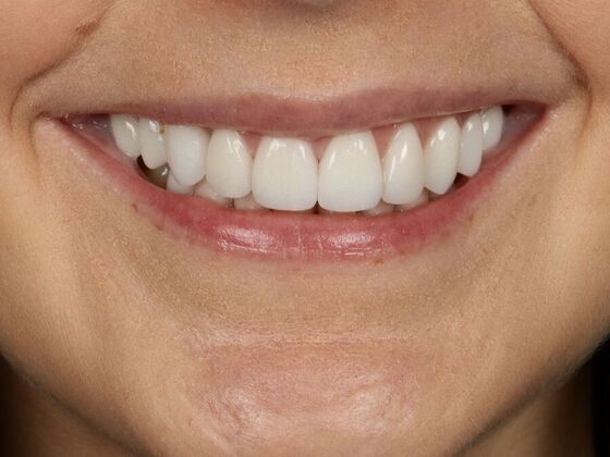 Porcelain Veneers: Caitlin - After