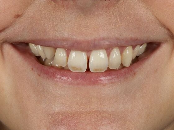 Porcelain Veneers: Caitlin - Before