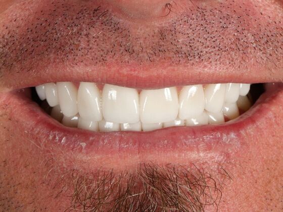 Porcelain Veneers: Mike - After