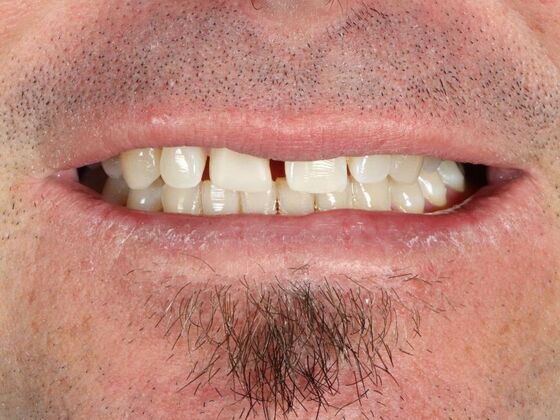 Porcelain Veneers: Mike - Before