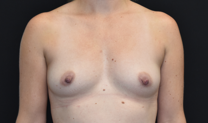 Breast Augmentation Case 22 - Before