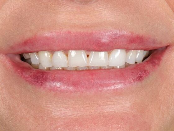 Full Mouth Rehabilitation: Paige - Before