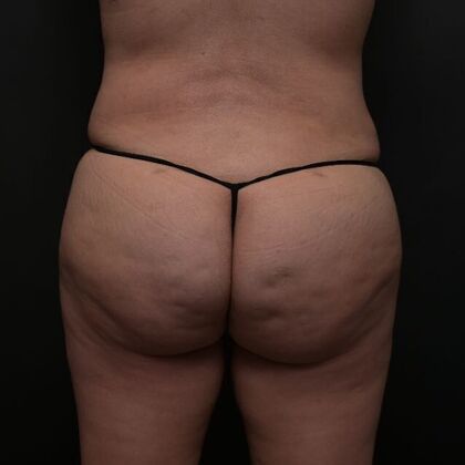 Brazilian Butt Lift Case 6 - After