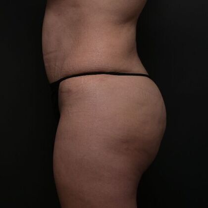 Brazilian Butt Lift: Case 6 - After