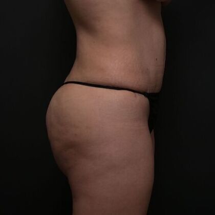 Brazilian Butt Lift: Case 6 - After