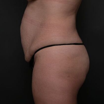 Brazilian Butt Lift: Case 6 - Before