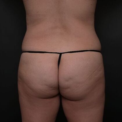 Brazilian Butt Lift Case 6 - Before