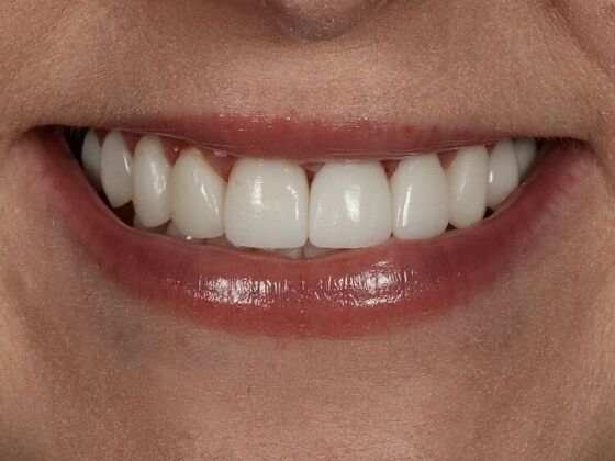 Dental Implants: Lauren - After