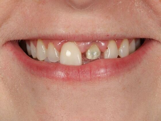 Dental Implants: Lauren - Before