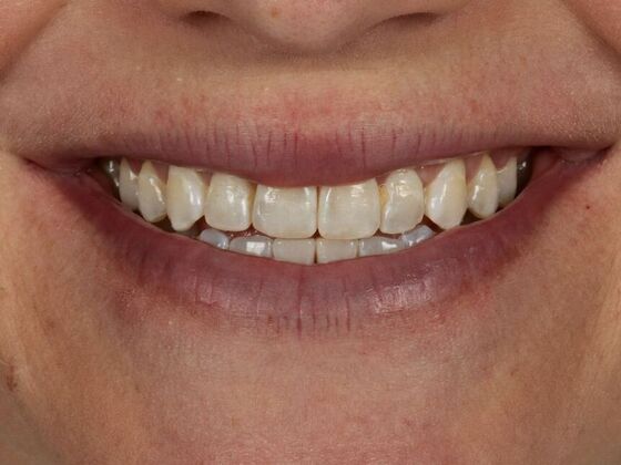 Porcelain Veneers: Jamie - Before