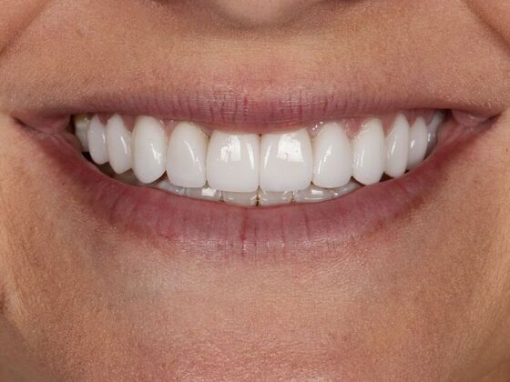 Porcelain Veneers: Jamie - After
