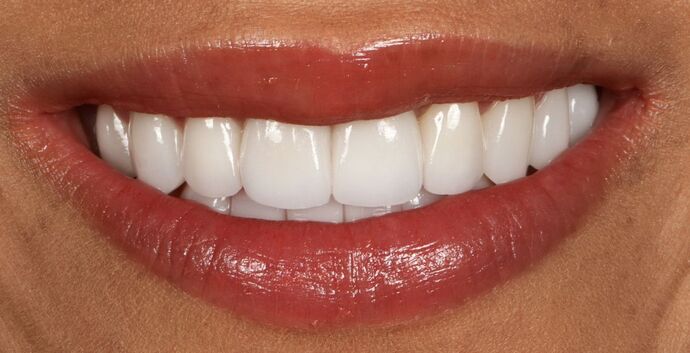 Full Mouth Rehabilitation: Noor - After