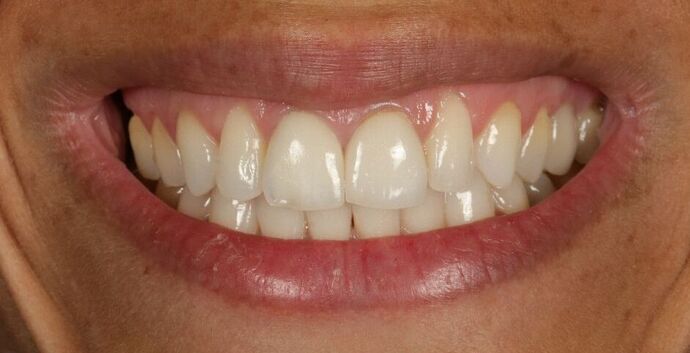 Full Mouth Rehabilitation: Noor - Before